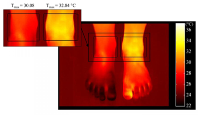 踝关节炎症时，炎症关节(左侧)的最大皮肤温度高于非炎症关节(右侧)。照片由东芬兰大学提供。